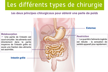 Types de chirurgie bariatrique